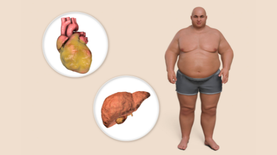 Obesity and an improper diet increase the risk of developing gout. 