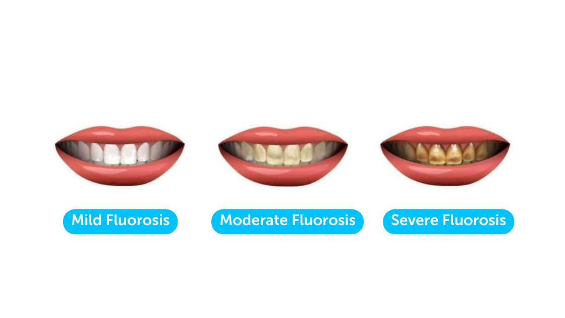 Dental Fluorosis in Nairobi, All You Need to Know