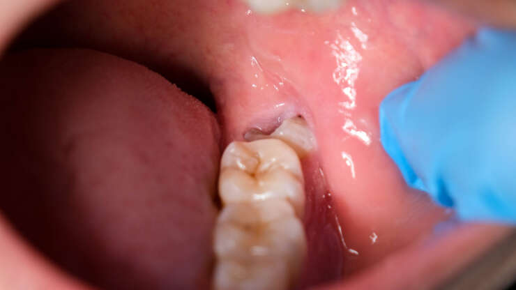 Impacted wisdom tooth? Here’s what disimpaction surgery actually involves
