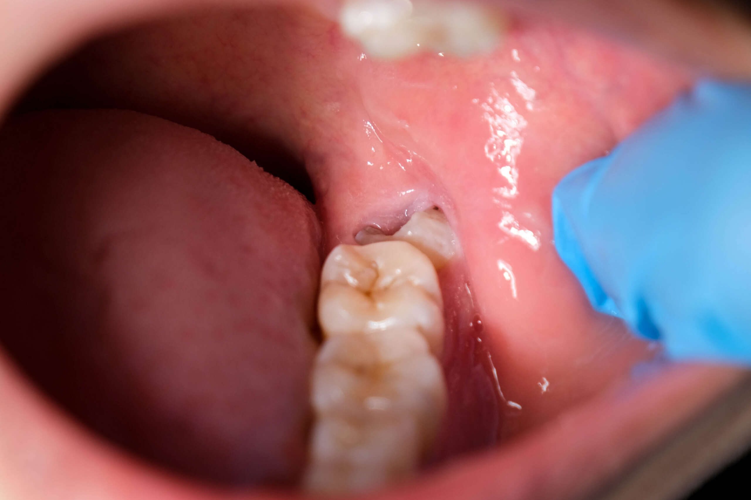 Impacted wisdom tooth? Here’s what disimpaction surgery actually involves